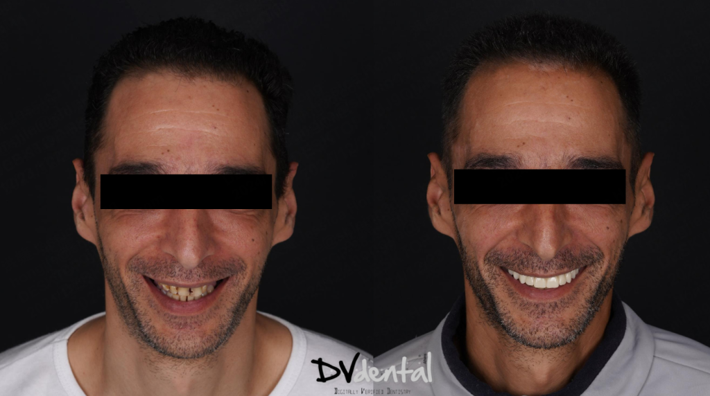 The face photo before and after the treatment