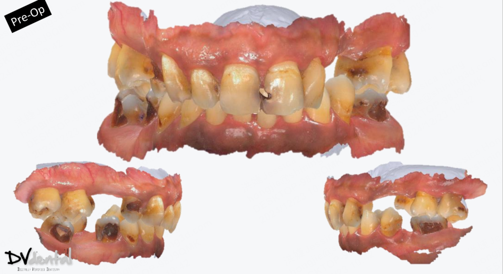Intraoral scan data before treatment