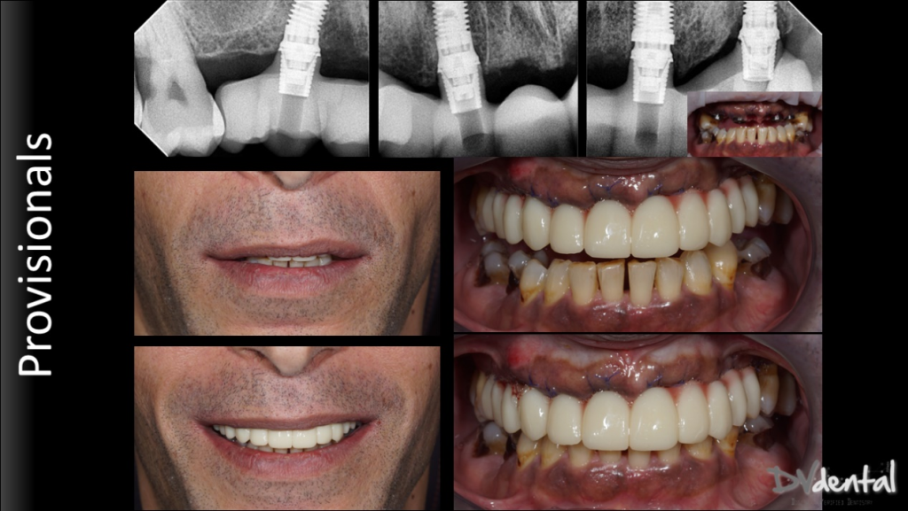The temporary restorations after implant surgery With Aoralscan Elite