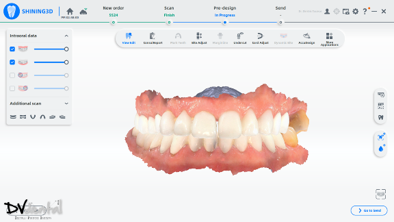 The intraoral scan data captured by Aoralscan Elite