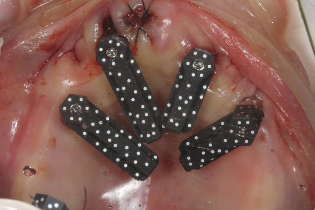SHINING 3D Dental immediate-load