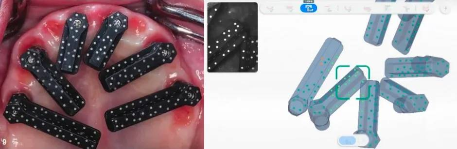 intraoral photogrammetry