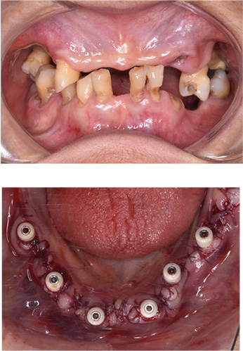 mandibular movement 